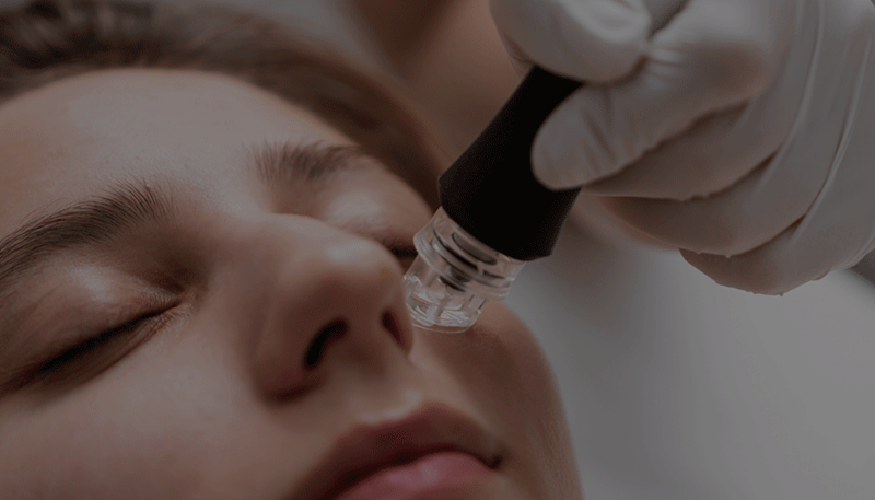 RF Micro Needling